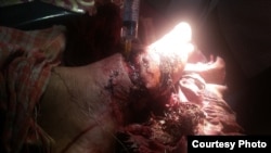 កញ្ញា ផន សុភាក់ ដែល​ជា​សកម្មជន​ដ៏​សកម្ម​ និង​ជា​តំណាង​បណ្ដាញ​សហគមន៍​ព្រៃឡង់​ ត្រូវ​ជន​មិន​ស្គាល់​អត្តសញ្ញាណ លប​កាប់​នឹង​ពូថៅ ត្រូវ​ចំ​ប្រអប់ជើង​ខាង​ឆ្វេង​ ដោយ​បណ្ដាល​ឲ្យ​របួស​ជា​ទម្ងន់ កាល​ពី​រំលង​អាធ្រាត្រ​ចូល​ថ្ងៃ​ទី​២៧​ ខែមីនា ឆ្នាំ​២០១៦​ នៅ​ចំណុច​អូតាជើល​ក្នុង​តំបន់​ព្រៃឡង់។ (រូបថត​ផ្តល់​ឲ្យ​ដោយ​បណ្តាញ​សហគមន៍​ព្រៃឡង់)